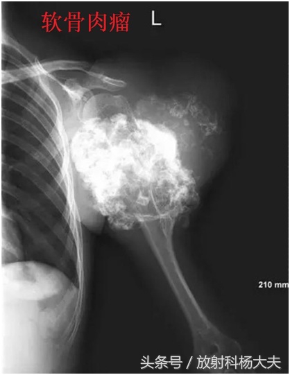 和骨肉瘤相似的病,骨肉瘤罕见病