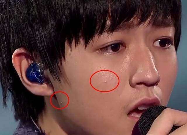 男生祛痘去痘印去油,如何祛痘印男士