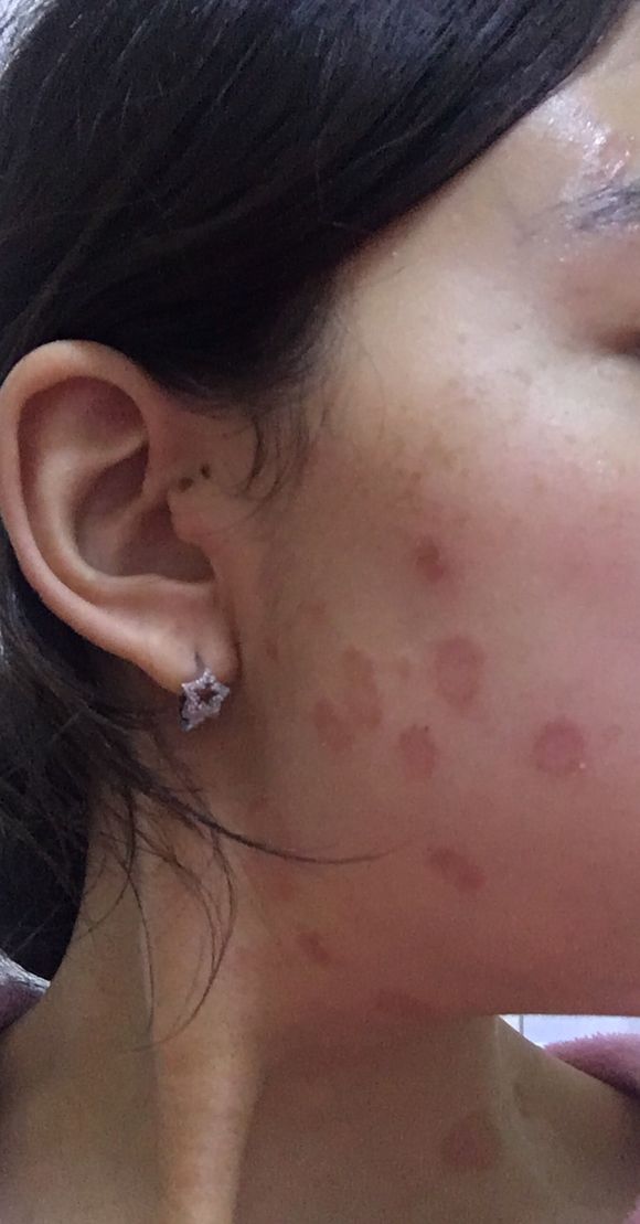 猫癣接触过的地方会传染吗,猫藓很容易传染给主人吗