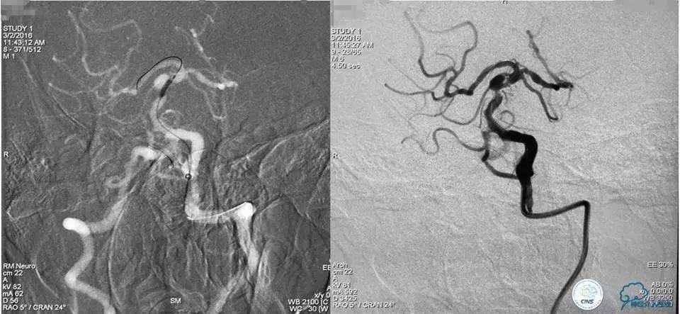 脑动脉瘤并颈动脉狭窄怎么治疗,脑动脉血管狭窄介入治疗效果好吗