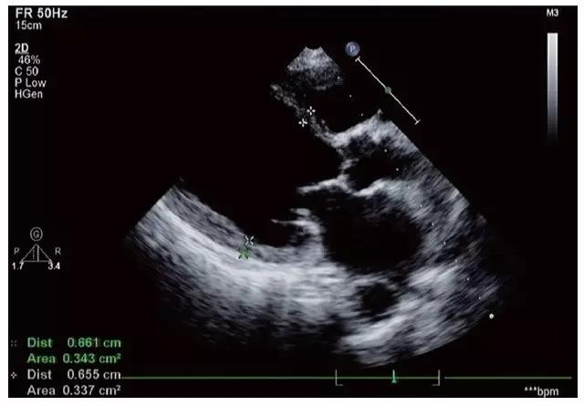 心脏扩大有什么症状和后果,心脏扩大症