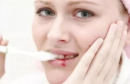 牙龈出血有哪些情况,小孩刷牙牙龈出血什么情况