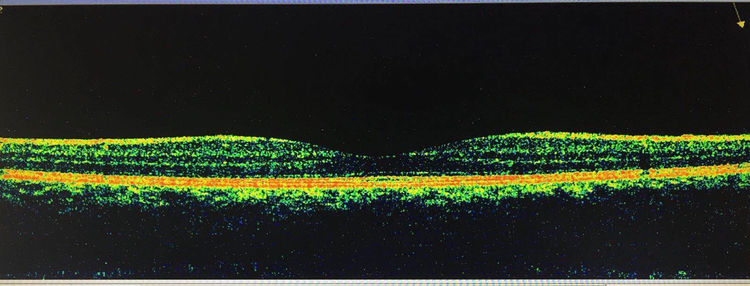 眼底黄斑凹陷怎么办,眼底黄斑怎么去除