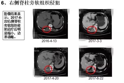 2023nkt细胞治疗肺癌效果,nkt肺癌免疫治疗