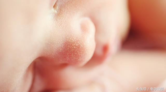 宝宝湿疹反反复复预防护理有技巧,宝宝湿疹总是反反复复怎么办