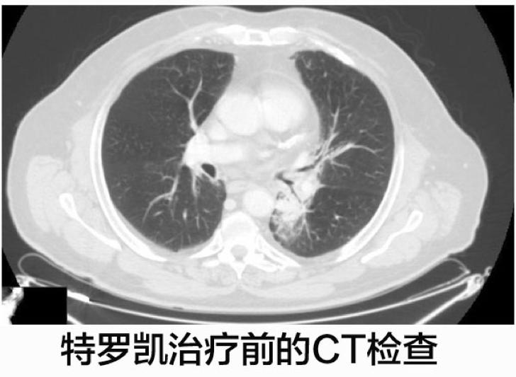 化疗失败后靶向药有效的案例,肺腺癌egfr突变耐药化疗