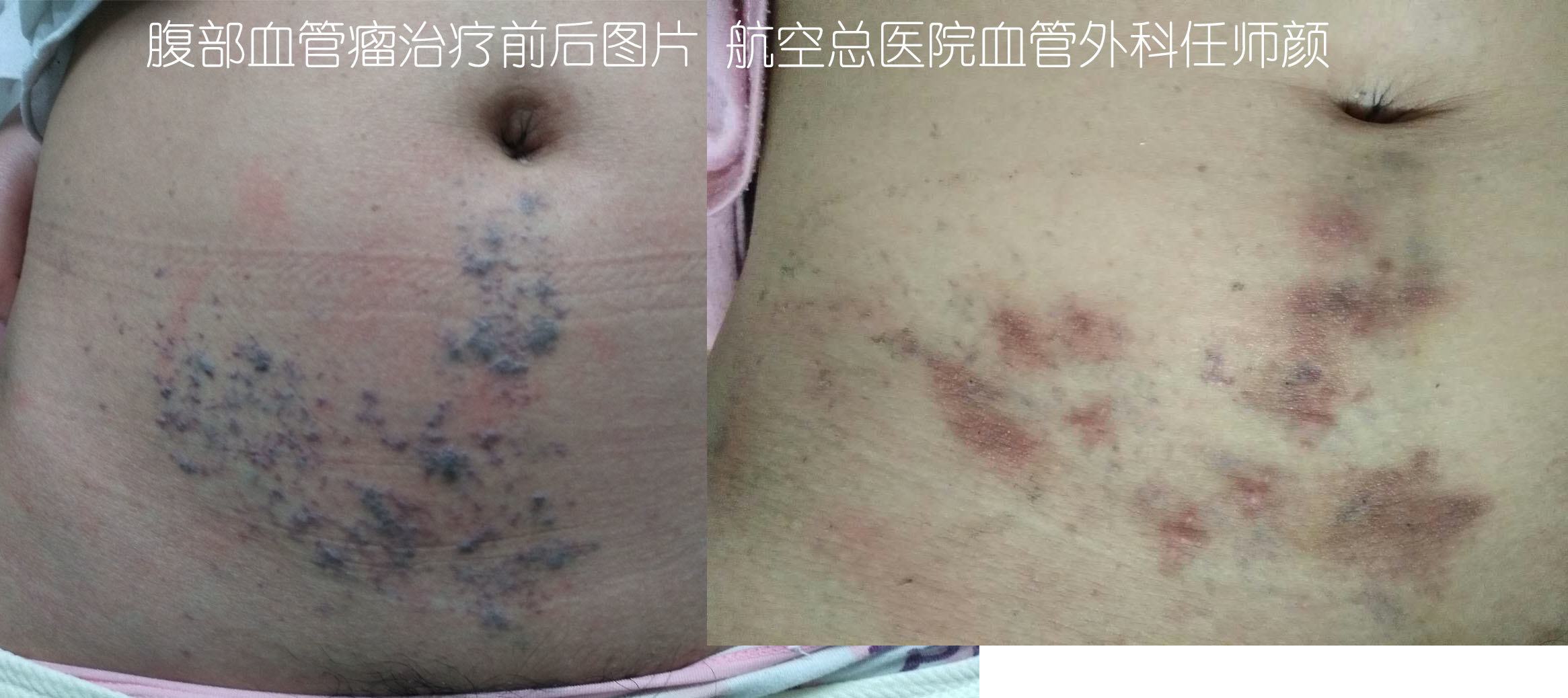 治血管瘤的药,倪海厦治血管瘤