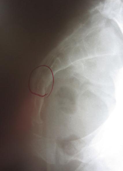 尾椎骨疼痛是什么原因怎么治疗,脊柱疼痛治疗