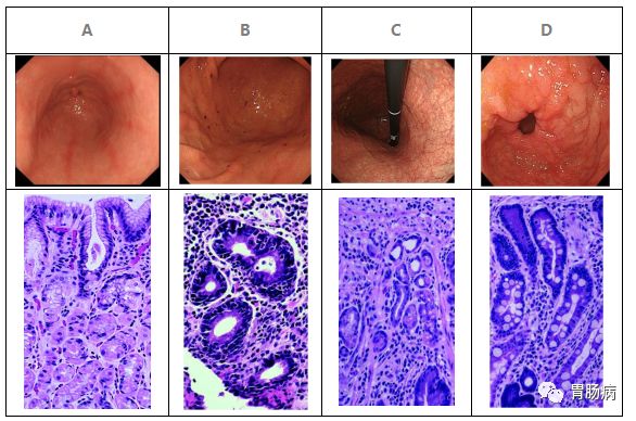 肠化是肠道出毛病了吗,胃萎缩肠化就是癌变的前兆吗
