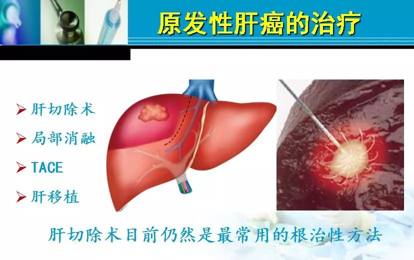 胆管肿瘤射频消融术,肿瘤射频消融厂家