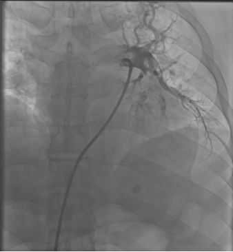 急性心梗病例讨论的意义,急性肺栓塞和急性心肌梗死