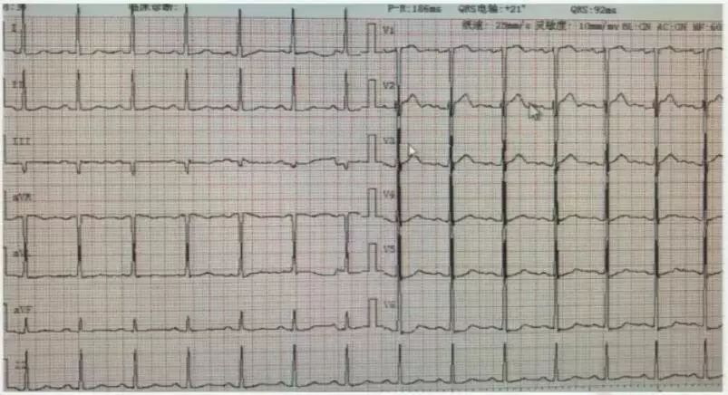 郑大一附院心血管内科专家陈英伟,房颤的治疗策略及进展