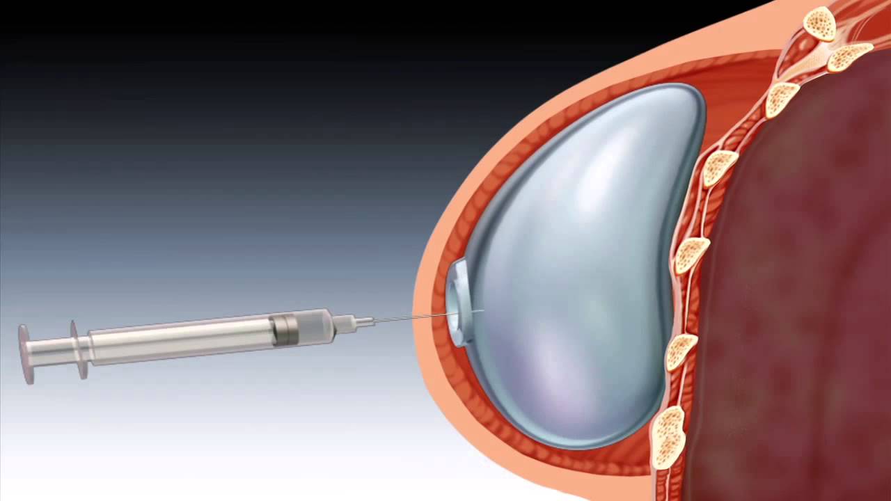 乳房全切和乳房重建能同时手术吗,乳房重建切口