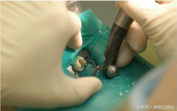 小孩牙齿根管治疗危害,根管治疗牙齿松动了能恢复吗