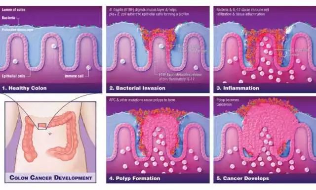 肠道菌群与癌症论文,21分钟详解肠道菌群与肿瘤5大问题