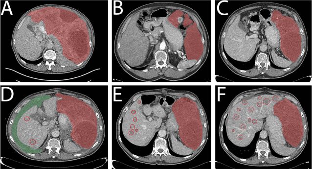 PubmedGIST文献月评第十四期(Jan.2018)