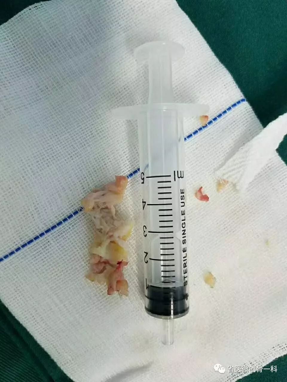 腰椎管狭窄的显微镜微创手术治疗,腰椎管狭窄椎间孔镜术后怎样康复