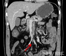 间歇性呕吐怎么回事,右上腹痛还伴有反酸