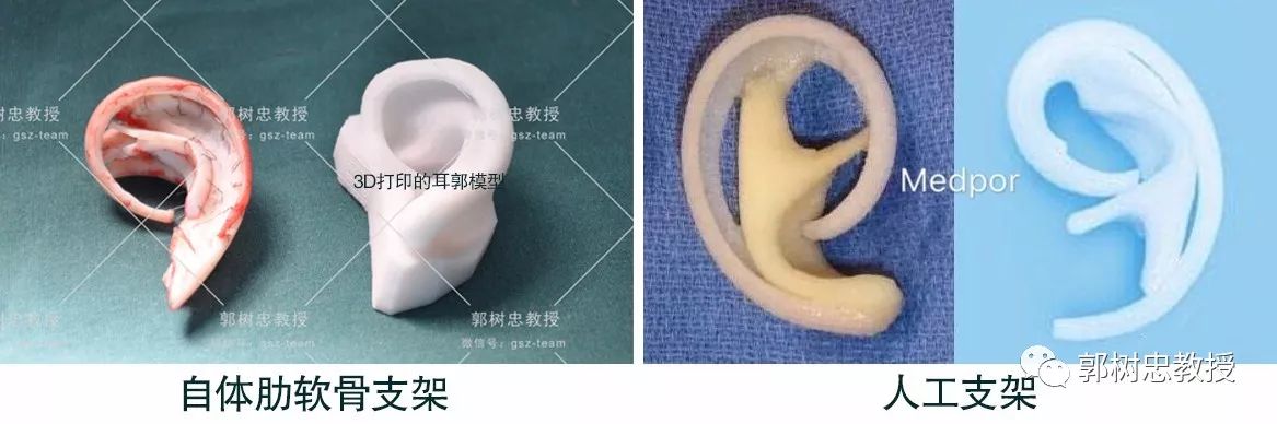 耳再造全过程,造耳朵技术