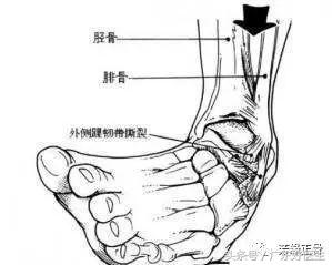 踝关节扭伤冷敷还是热敷,踝关节扭伤要冷敷还是热敷