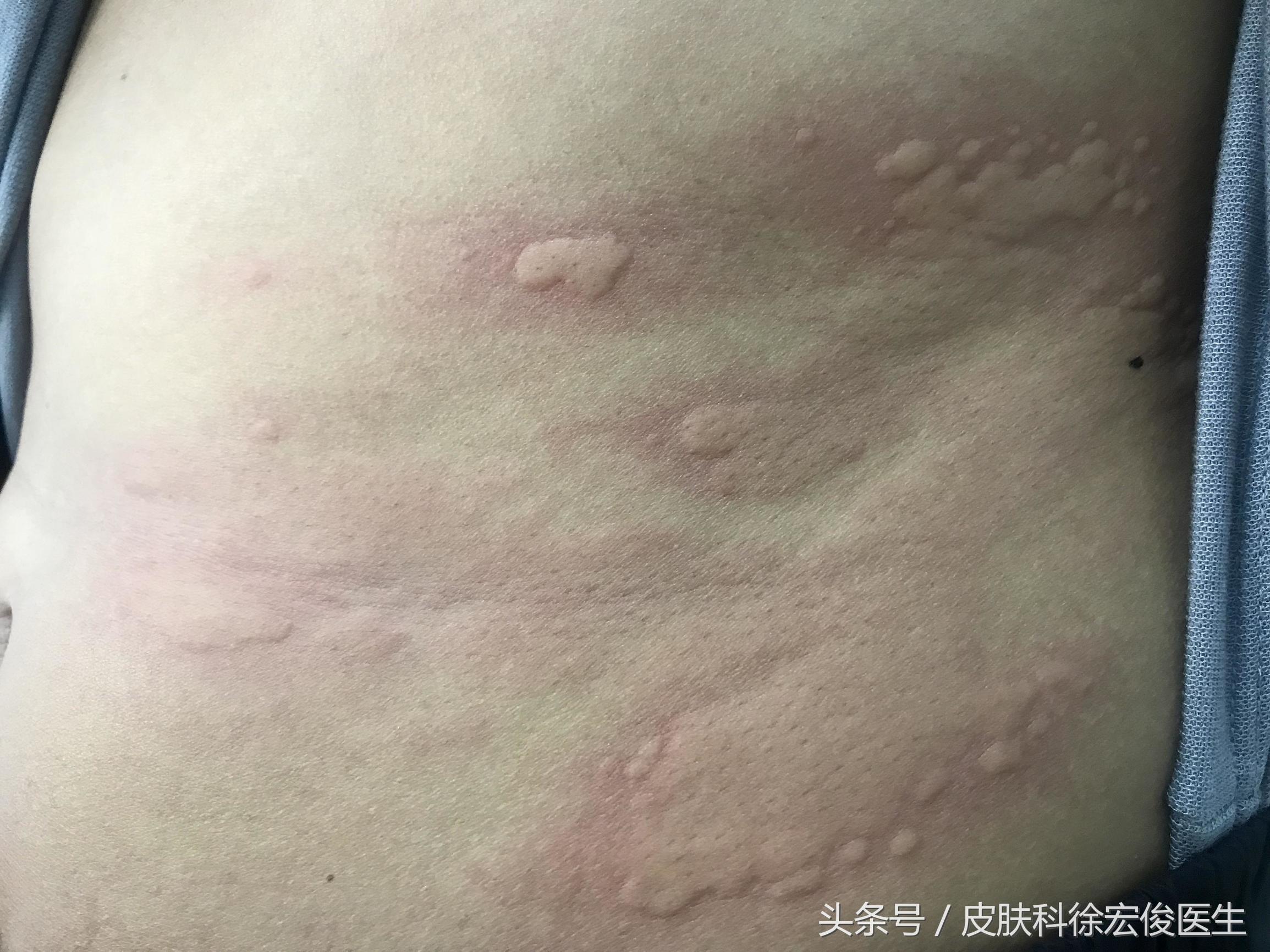 哪种类型的皮肤病能用激素,激素治疗皮肤病荨麻疹