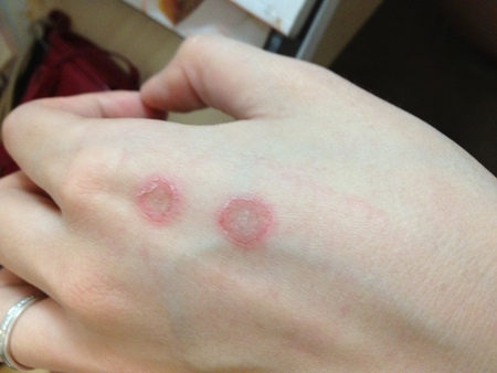 猫皮癣传染人,猫狗癣传染人有什么症状