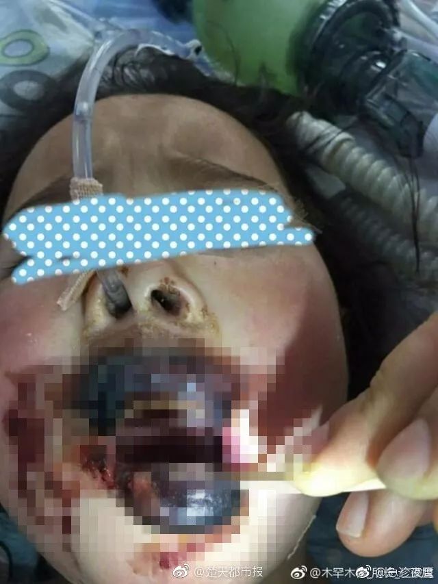 阿娇刮痧后背效果,阿娇被吓哭