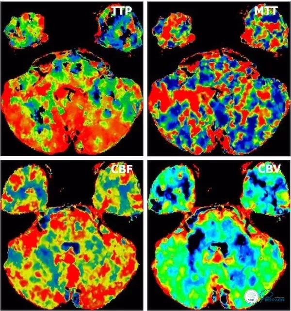 天坛医院做椎动脉狭窄多少要手术,天坛椎动脉狭窄