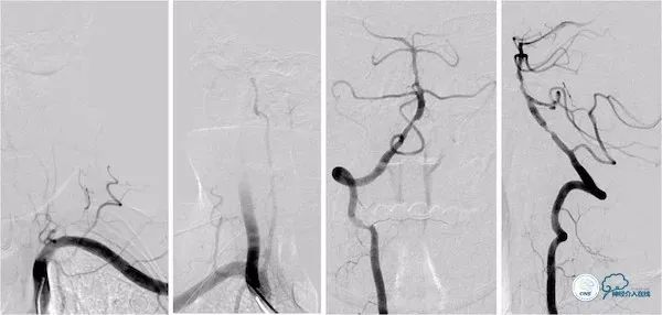 天坛医院做椎动脉狭窄多少要手术,天坛椎动脉狭窄
