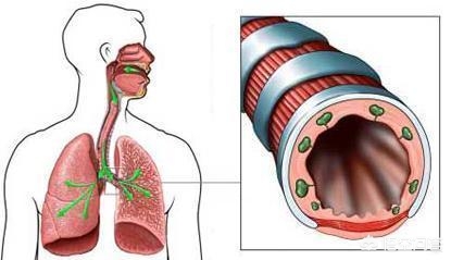 支气管扩张能治好吗,支气管扩张可以完全治愈吗
