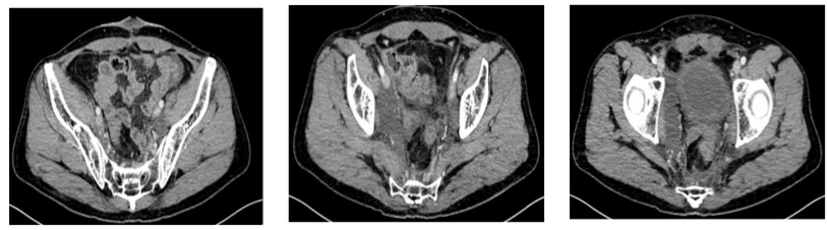 直肠腺癌肺转移最好的治疗方案,得了直肠腺癌不治疗能活几年