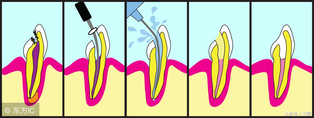根管治疗真的有必要做吗,根管治疗真的有必要吗