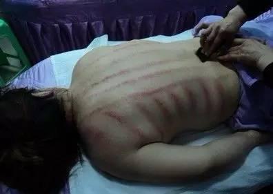 风寒感冒刮痧刮哪个部位,感冒鼻子不通气刮痧刮哪个部位