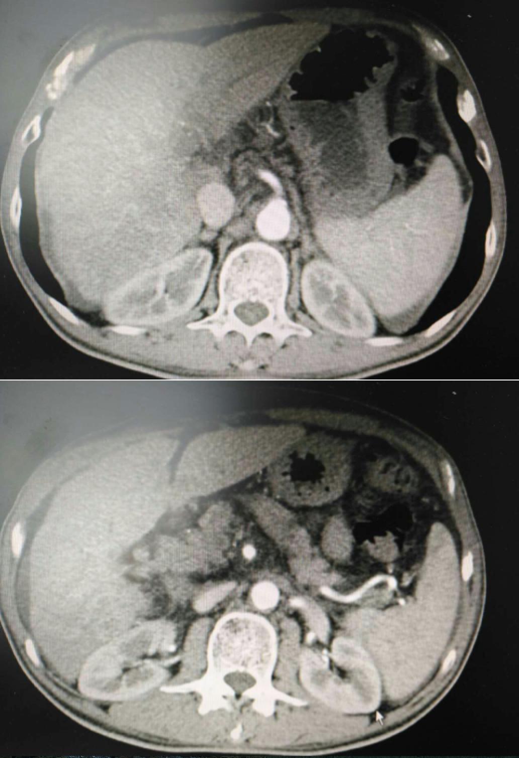 肝癌病例实例100例,肝癌的治疗方法论文