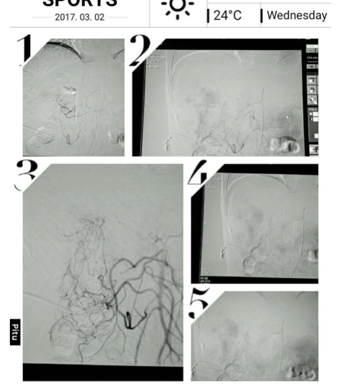 周仲国评价肝癌病例,周仲国分享肝癌早期复发