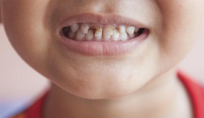 爱优牙牙齿矫正攻略,美牙中牙黄用什么处理牙齿会变白
