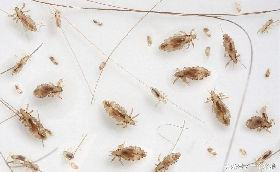 你对虱子和虮子只停留在上世纪六七十年代吗?国外现在还有