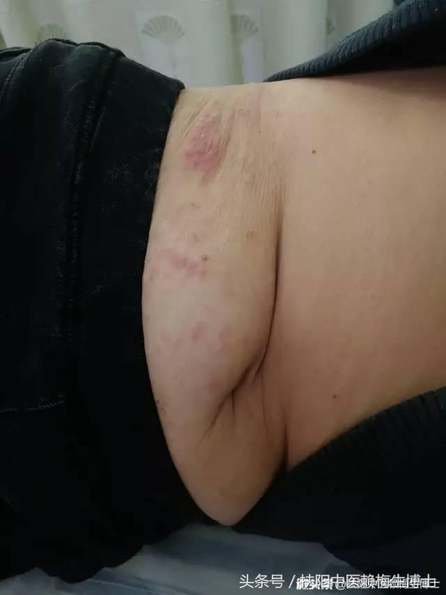 治疗带状疱疹用针灸和放血,带状疱疹内针治疗