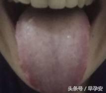 孕吐厉害如何缓解补充什么,孕吐怎么缓解胃酸过多