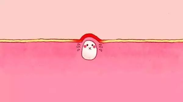 CiCi年希老师：闭口粉刺是什么？那么多人分不清楚它和痘痘的关系