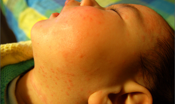 骞煎効鎬ョ柟鍖荤敓缁欏紑浜嗕粈涔堣嵂,骞煎効鎬ョ柟鏃跺濡堣鎬庝箞蹇屽彛