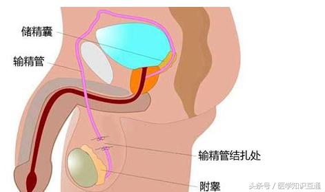 避孕方式排行榜,哪种女人最舒服最安全?