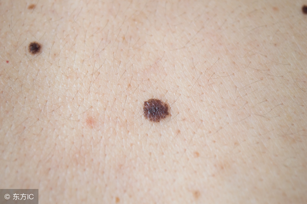 指甲黑色素瘤是什么原因引起的,舌头上的黑色素瘤是什么症状