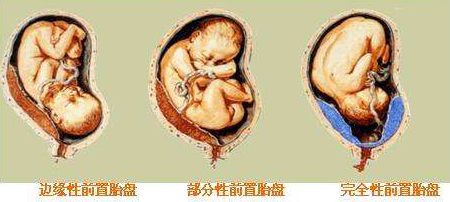 凶险性前置胎盘有多危险看一看吧,前置胎盘的预防方法和护理方法