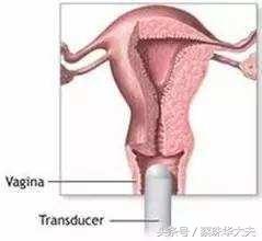 怀孕做阴道B超，会引起流产吗？