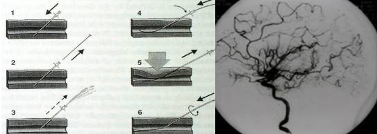 火视231|CookMedical：不断创新心血管介入治疗器械