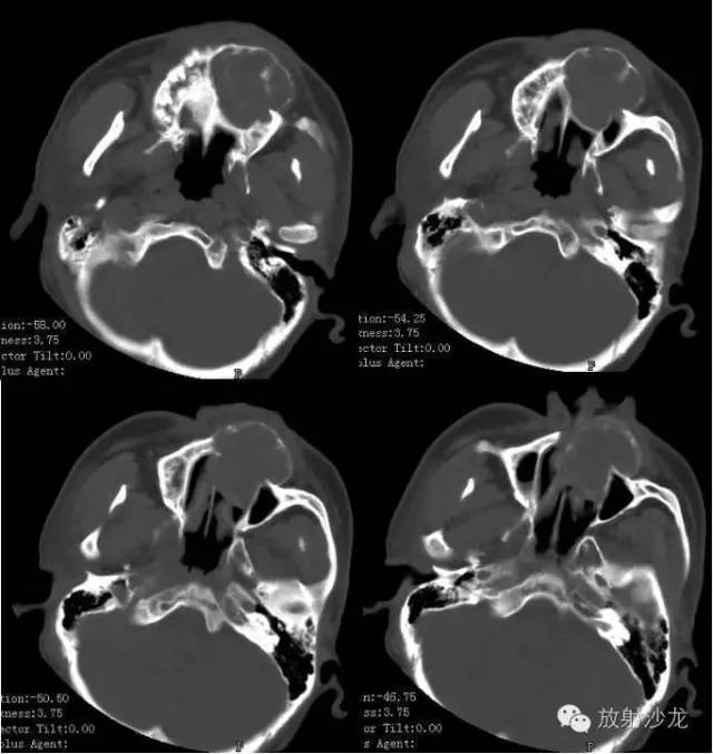 巨细胞性肉芽肿治疗费用,颌骨巨细胞修复性肉芽肿x线表现