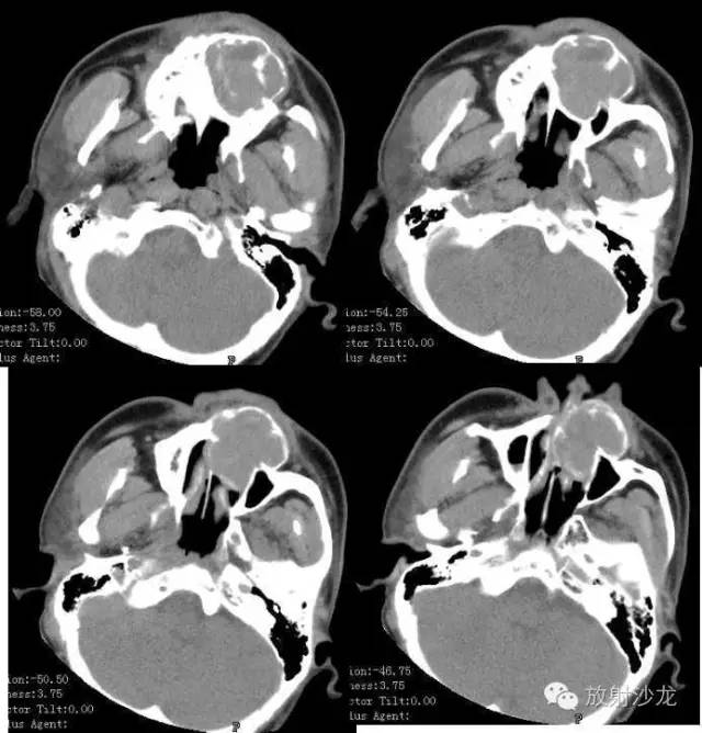 巨细胞性肉芽肿治疗费用,颌骨巨细胞修复性肉芽肿x线表现