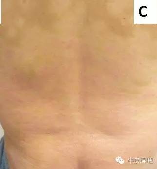 皮肤科专家谈论银屑病生物制剂,中国治疗银屑病新药生物制剂