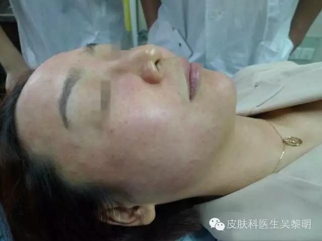 透明质酸护肤品功效,透明质酸是修复皮肤敏感成分